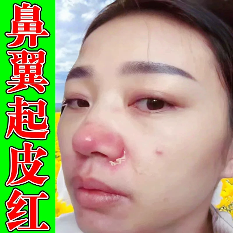 鼻子两侧发红脱皮鼻翼两边泛红干燥起皮掉皮酒糟鼻治红鼻头专用膏