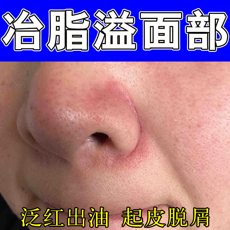脂溢性鼻侧泛红干痒粗糙起干皮掉皮屑鼻子两边发红痒修复保湿软膏