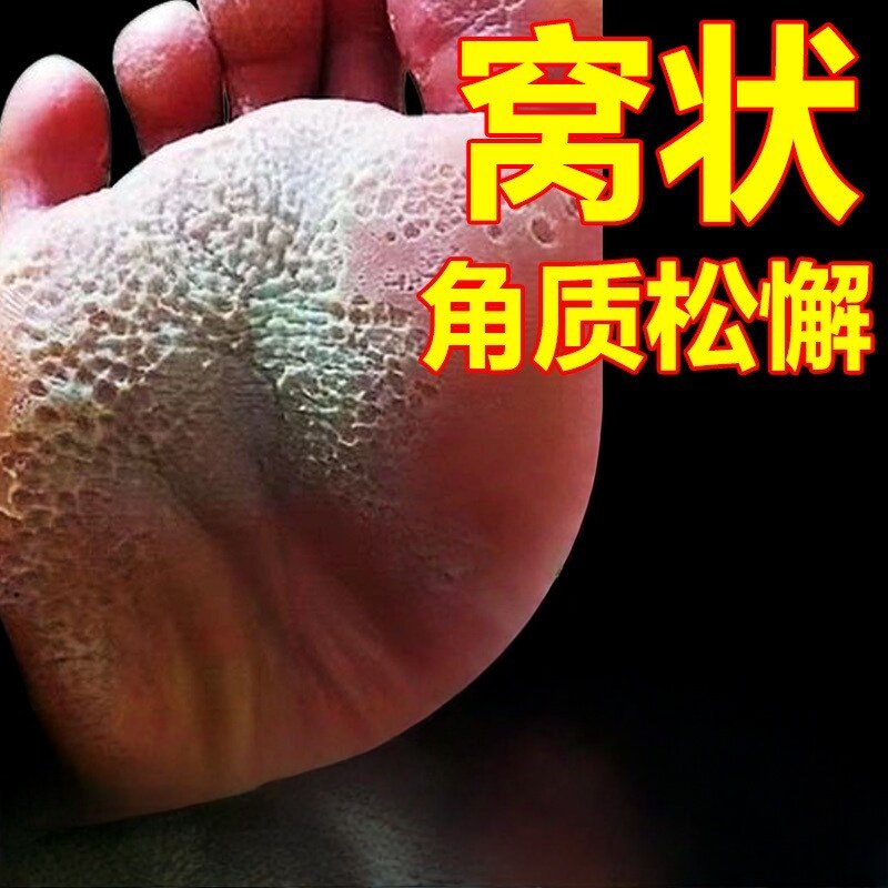 窝状角质松解症脚底起泡蜂窝状沙虫脚脚出汗臭脚汗痒膏