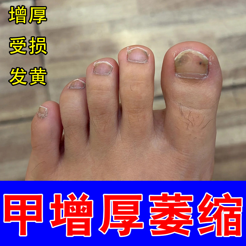 脚指甲发黄变厚硬指甲增厚真菌指甲黄空甲分层开裂修护保湿指甲液