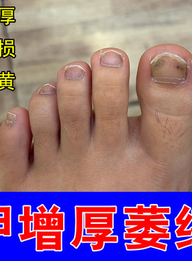 脚指甲发黄变厚硬指甲增厚真菌指甲黄空甲分层开裂修护保湿指甲液