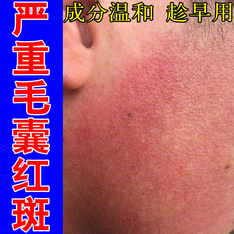 毛囊红斑黑变脸颊毛囊粗糙疙瘩暗沉脸毛周角化泛红黑粗糙修护膏