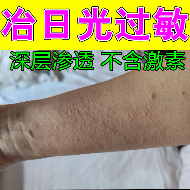 日光性过敏疙瘩痒刺痛紫外线专用阳光晒伤手臂痒疙瘩红肿修护软膏