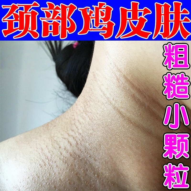 颈部脖子上颗粒皮疙瘩毛囊角化软膏手臂脸部腿上毛周角化焱去膏