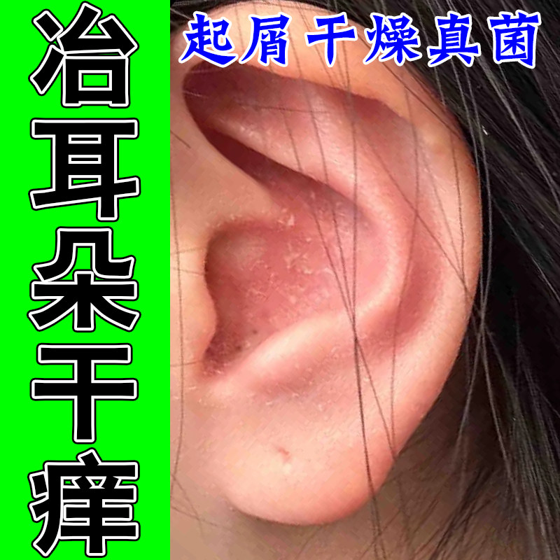 耳朵反复发痒脱皮干屑耳内结痂干燥真菌痒开裂紧绷红肿起皮干膏