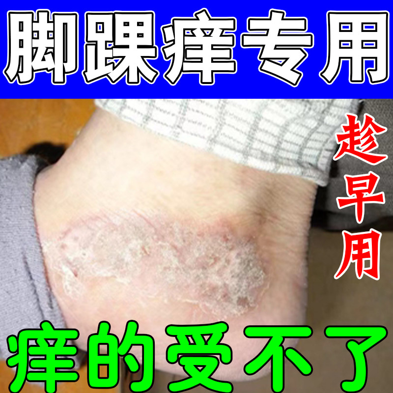 冶脚踝疙瘩起屑痒脚踝红肿长硬疙瘩脚踝粗糙泛红长疙瘩痒专用乳膏
