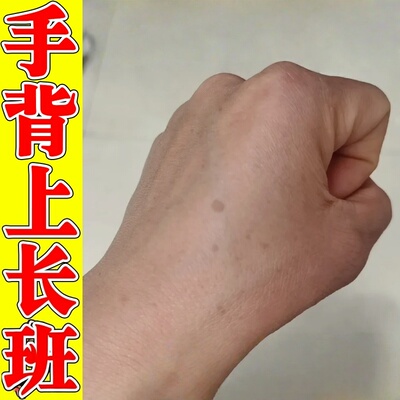手背老年班去除手部手上黑班淡老年黄褐雀班黑色素软膏