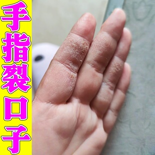 手指头裂口子干裂修复霜手脚脱皮开裂脚后跟干裂感染真菌秋冬防裂