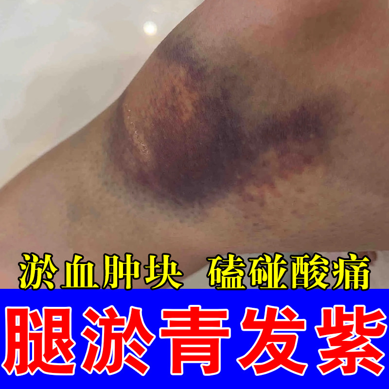 腿上淤青跌打损伤化瘀舒筋消红肿肌肉撞伤发紫拉扭摔伤按摩专用膏