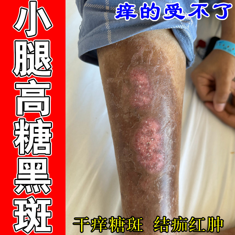 皮肤糖斑暗沉色素沉淀全身皮肤干燥脱皮反复疼肿胀痒植物修护膏