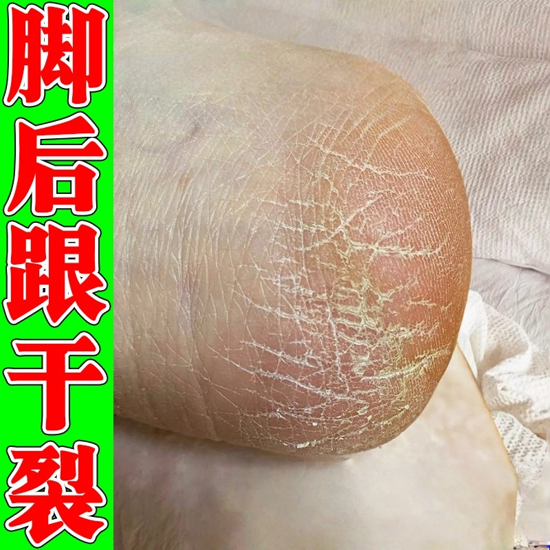 脚后跟干裂起硬皮足跟开裂感染真菌治脚裂手脚/脱/皮防皲裂修复霜