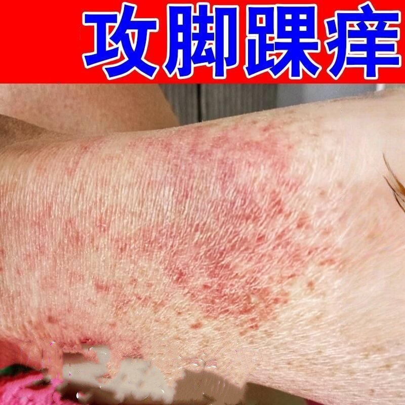 脚踝痒脚面痒脚脖子上起红斑点脚踝痒感染/真菌皮痒诊/湿膏