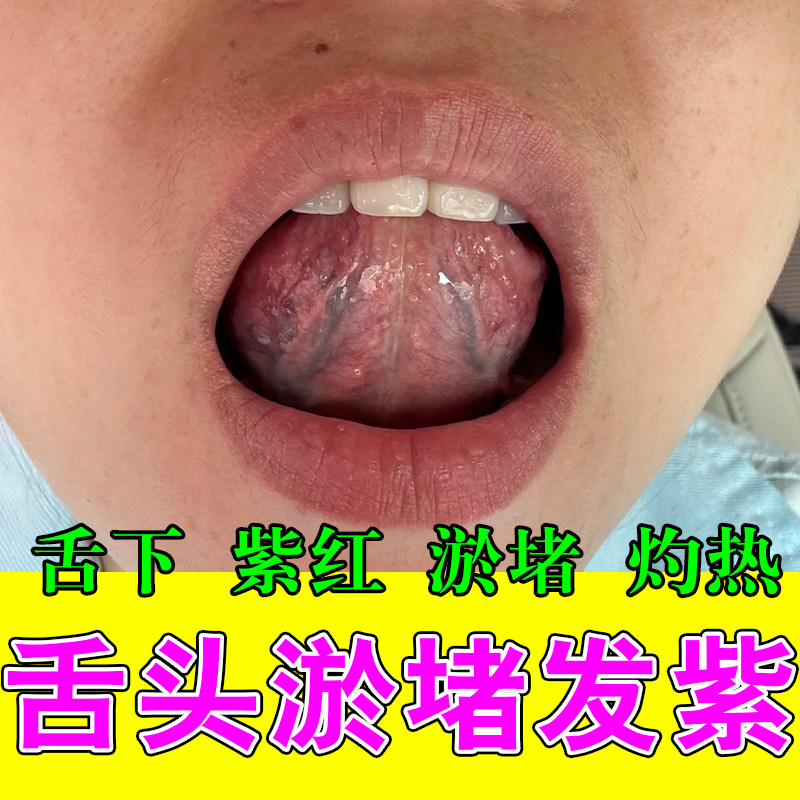 草本疏通舌下粗黑青筋舒缓舌根肿痛舌底血管淤堵塞草本喷剂