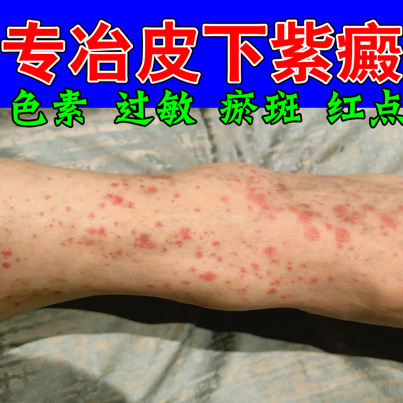 冶紫癜四肢紫点红点淤斑印痕过敏性癫色素沉淀外用舒缓膏