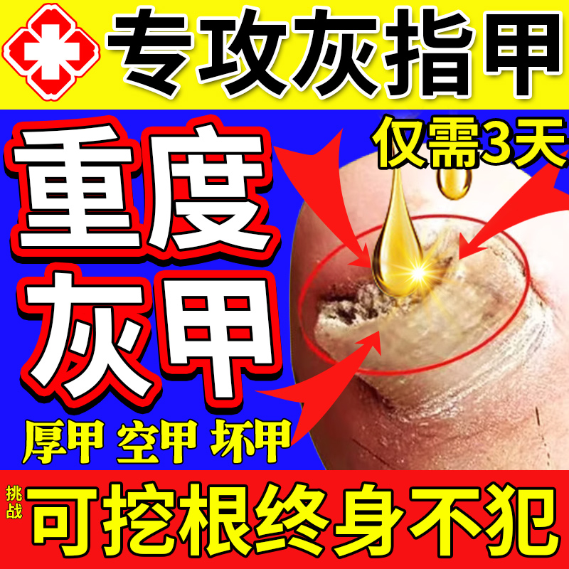 【自营】灰指甲特效药根治第一名专用药正品官方旗舰店亮治疗灰甲