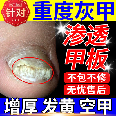 【自营】灰指甲特效药根治第一名专用药正品官方旗舰店亮治疗1甲