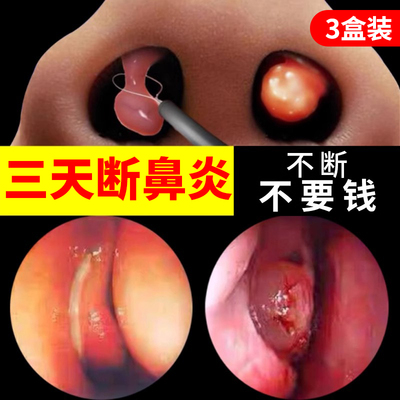 【自营】慢性鼻炎专用特效药膏儿童喷雾剂软膏断根官方正品鼻窦炎