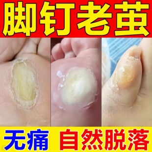 脚钉祛除膏去除厚脚垫老茧死皮根去脚底板脚掌趾指头硬皮软化剂药