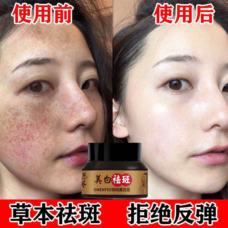 中医美白祛斑霜去褐斑雀斑遗传斑老年斑晒斑美白淡斑淡化色斑
