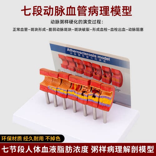 仿真人体动脉粥样硬化堵塞模型