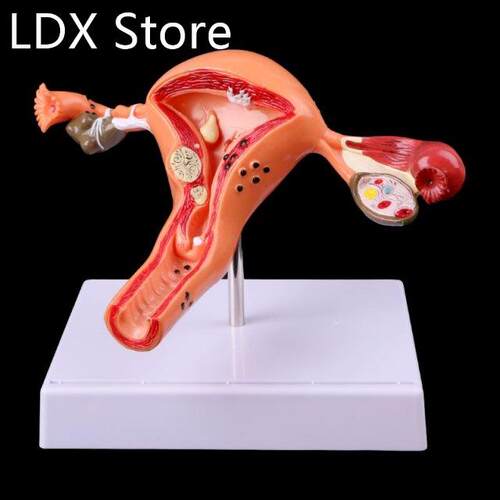 Medical props model Free postage Pathological Uterus Ovary A