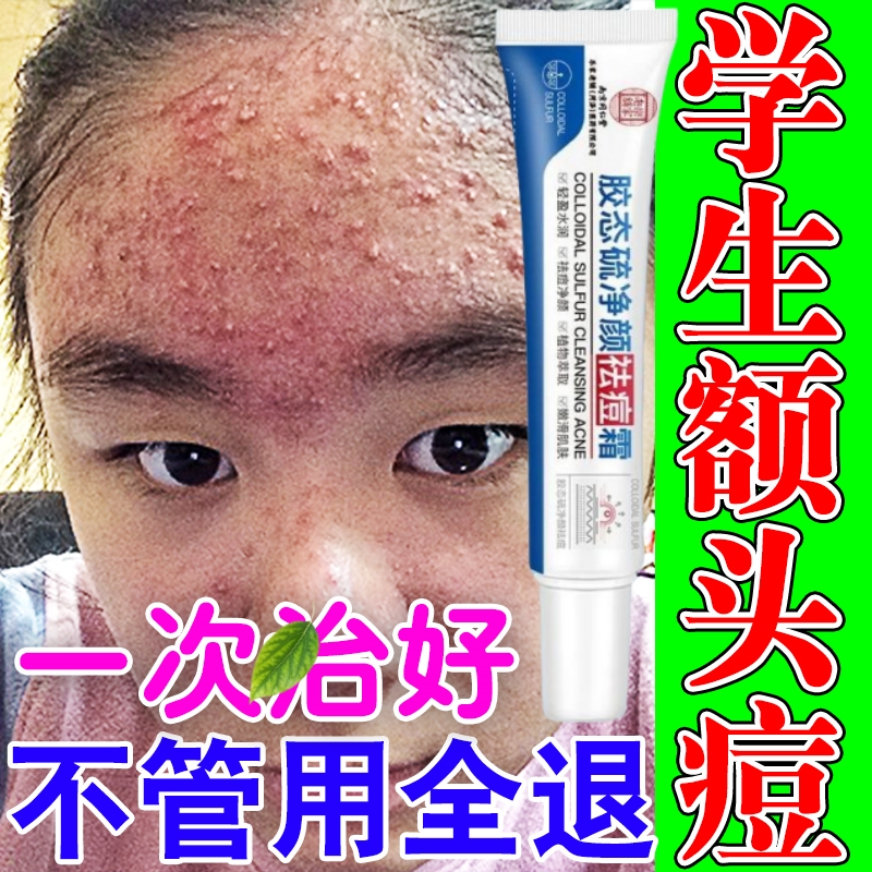 痤疮膏祛痘重度暗疮闭口粉刺克星去青春痘祛痘印玫瑰痤疮特效药膏