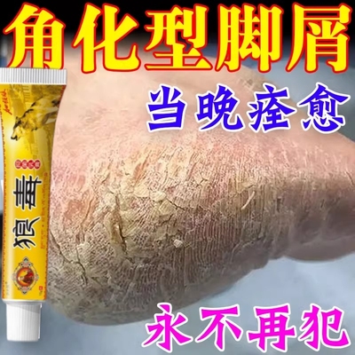 鳞屑角化型脚气专用喷雾脚后跟干裂根去狼毒真菌感染足藓增厚硬化