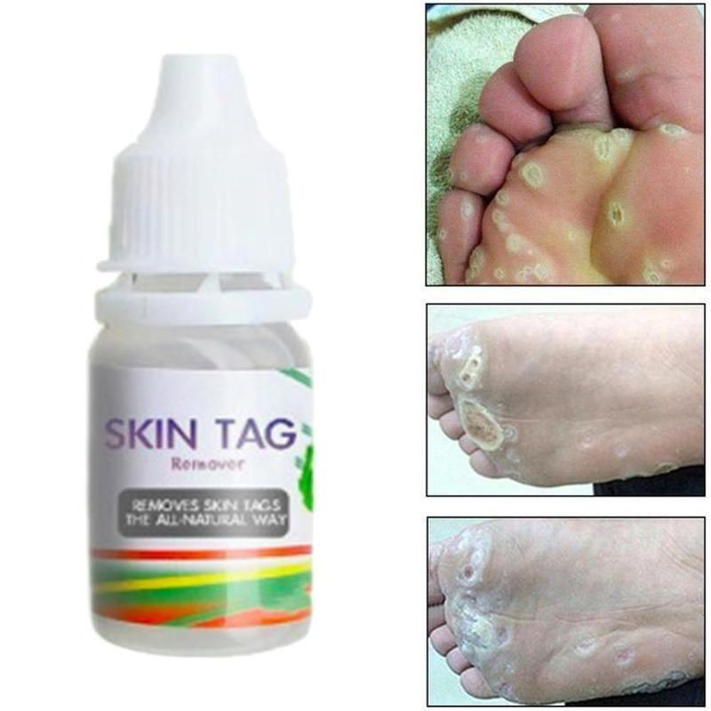 2pcs plantar genital warts ointment skin tag remover cream