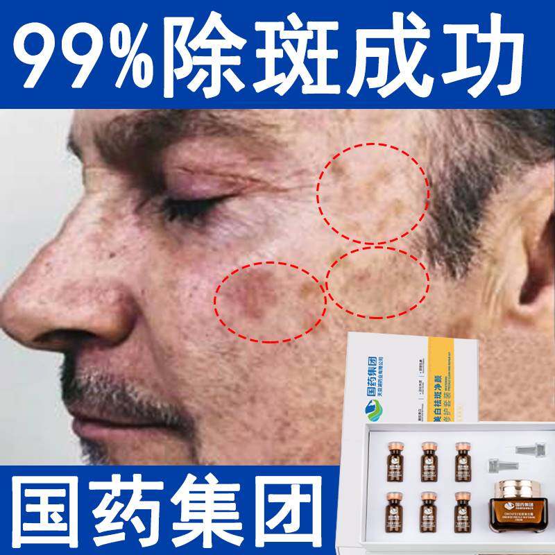 美白祛斑霜祛斑神器男士专用去斑祛黄褐斑雀斑手部脸部产品护肤品
