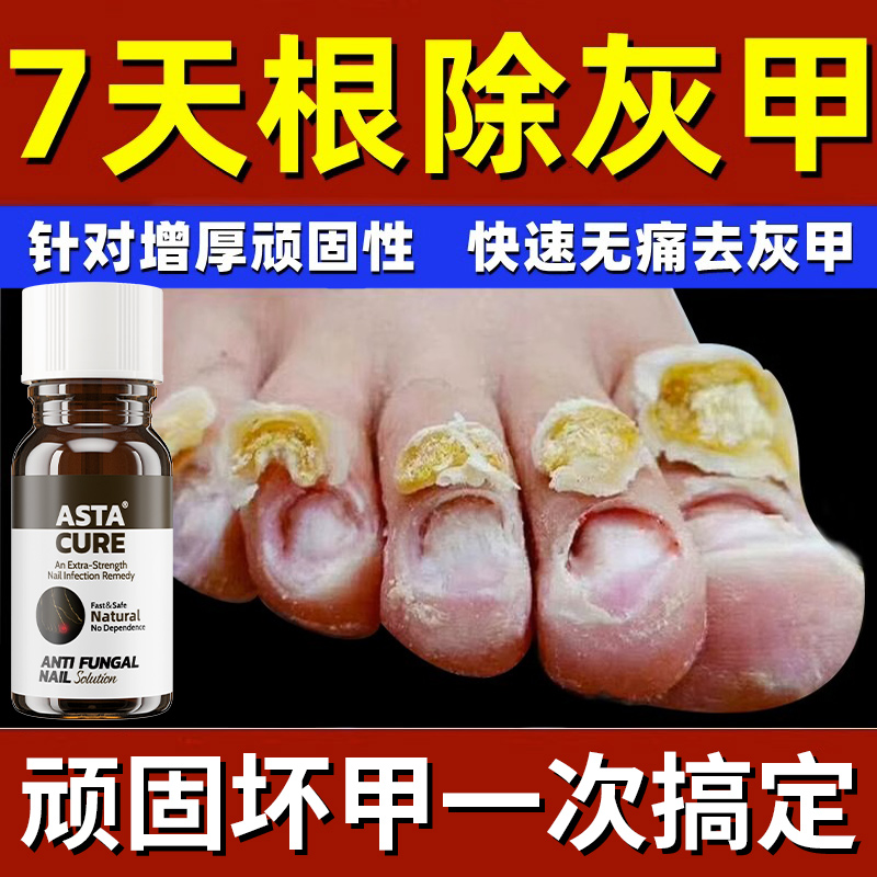 灰指甲专用药正品旗舰店特效药水阿莫罗芬搽剂剪刀钳冰醋酸30抗菌