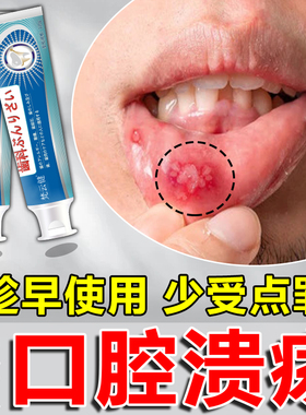 口腔溃疡专用牙膏成人儿童上火舌头溃疡牙龈出血肿疼痛含漱液凝胶