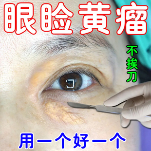 眼睑黄瘤去除药膏眼部睑黄瘤眼角瘤黄色瘤黄斑黄色肉块专用膏
