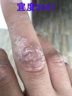 啥药膏能治身体鸡皮疙瘩(身上出鸡皮疙瘩吃什么药管用)