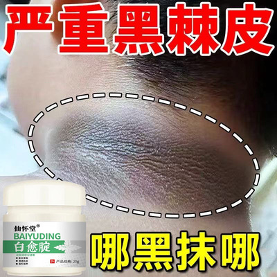 脖子黑色素去除黑棘皮病药膏颈部美白霜淡化身体皮肤沉淀修复神器