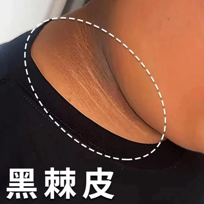 脖子黑色素去除黑棘皮病药膏颈部美白霜淡化身体皮肤沉淀修复神器