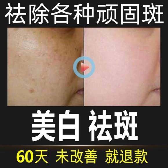 【国妆淡斑】南京同仁堂祛斑霜祛黄褐斑雀斑晒斑老年斑 买3发5