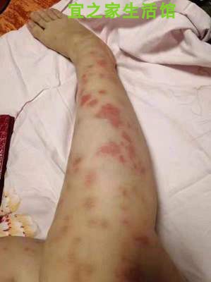 大腿内侧红斑牛皮癣健驰百夫灵软膏皮肤抑菌苦参瘙痒百肤灵药膏大