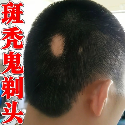 鬼剃头特药效斑秃后脑勺块状脱发毛囊受损修护专用喷剂
