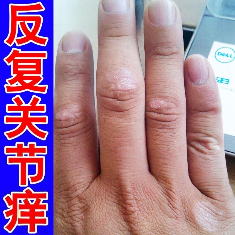 手指关节痒皮肤真菌感染发痒增厚硬块干燥脱皮手指关节垫外用乳膏,保健用品,皮肤消毒护理（消）,淘宝优惠券,粉丝福利购,淘宝优惠卷