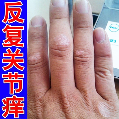 手指关节痒皮肤真菌感染发痒增厚硬块干燥脱皮手指关节垫外用乳膏