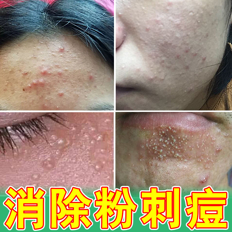 闭口粉刺乳膏去除脸上面部痘坑痘印粉刺黑头小疙瘩青春痘外用软膏