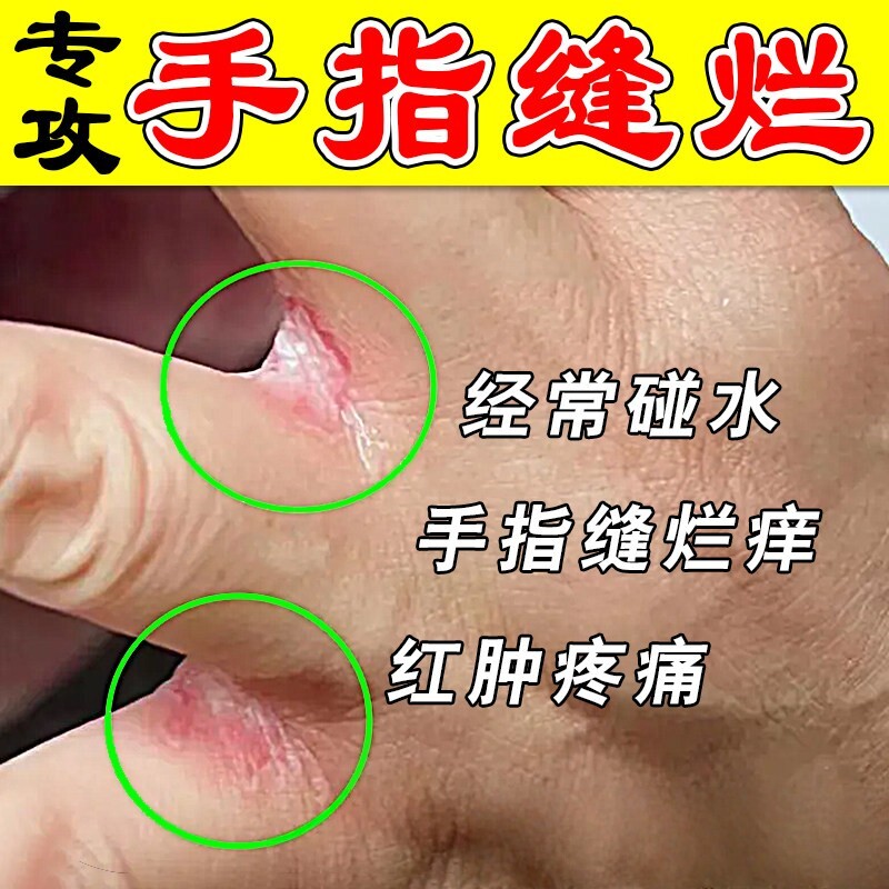 手干裂泛红专用膏手指缝干裂发肤皮肤消毒护理（消）