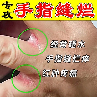 烂手丫专用膏药手指缝溃烂发痒脱皮干裂真菌感染糜烂起水泡修复膏