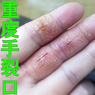手裂口子干燥粗糙爆干皮干痒缺水粗糙指缝指腹开裂手干裂修复乳膏