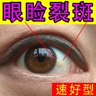 黄斑眼药水色素斑眼白发黄病变眼疲劳去红血丝肉疙瘩视物变形黑影
