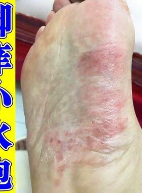 脚底上起小水泡又痒又脱皮脚痒脚心侧面起皮长小红点草本软膏