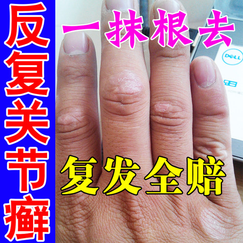 手指关节癣皮肤真菌感染瘙痒增厚硬块干燥脱皮手癣手指裂口特效药