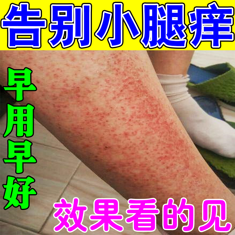 秋冬腿痒小腿皮肤干燥止痒抑菌药换季长红疙瘩过敏红斑点修复软膏