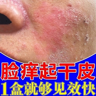 脸上发痒干皮脸部皮肤干燥起皮有碎屑眼皮样除过敏红肿痒修复膏药
