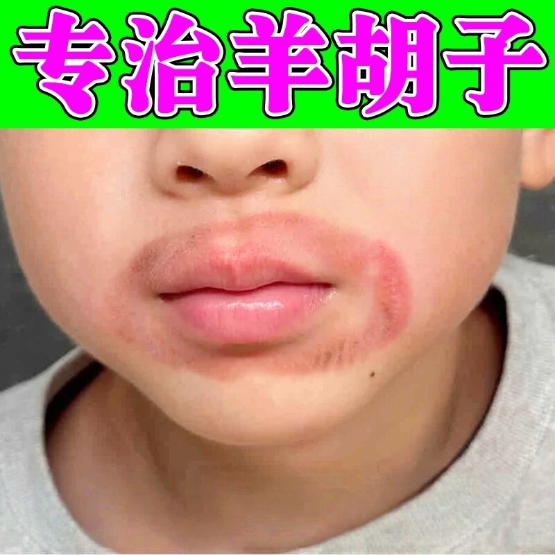 小孩嘴周红防止舔嘴唇羊胡子疮膏药嘴巴一圈红干裂红肿口角炎上火
